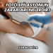 Foto Epilasyonun Zararları Nelerdir?