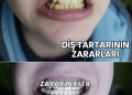 Diş Tartarının Zararları