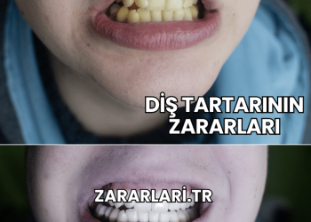 Diş Tartarının Zararları