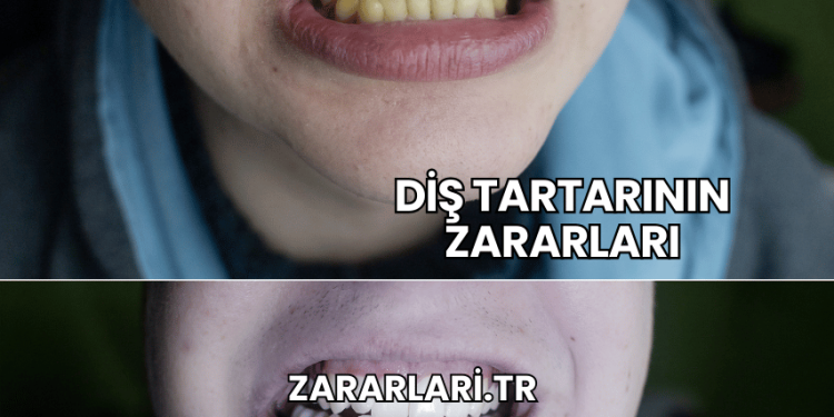 Diş Tartarının Zararları