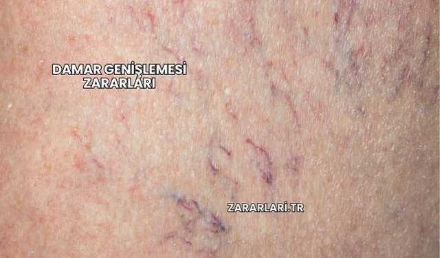 Damar Genişlemesi Zararları