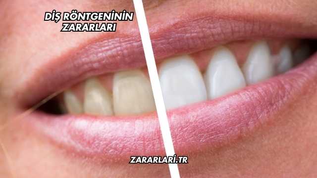 Diş Röntgeninin Zararları