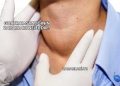 Guatr Hastalığının Zararları Nelerdir?