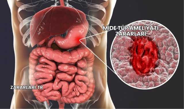 Mide Tüp Ameliyatı Zararları