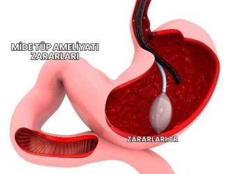 Mide Tüp Ameliyatı Zararları
