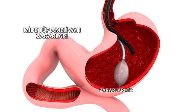 Mide Tüp Ameliyatı Zararları