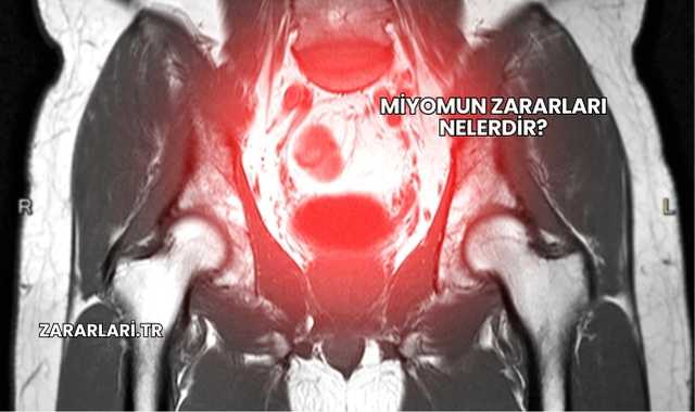 Miyomun Zararları Nelerdir?