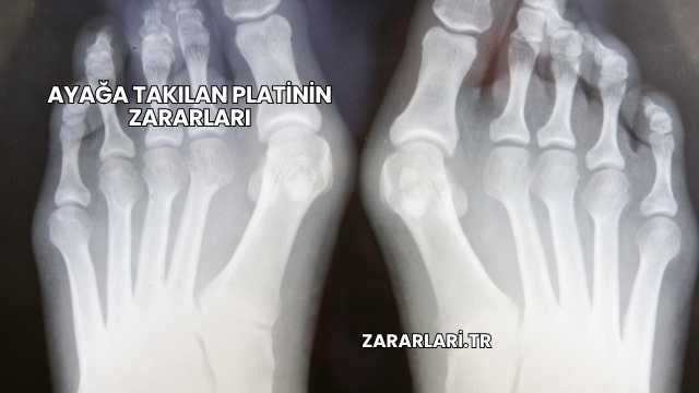 Ayağa Takılan Platinin Zararları