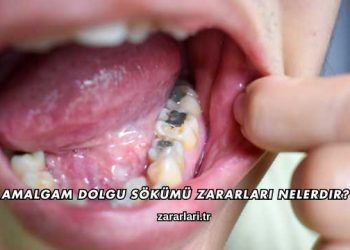 Amalgam Dolgu Sökümü Zararları Nelerdir?