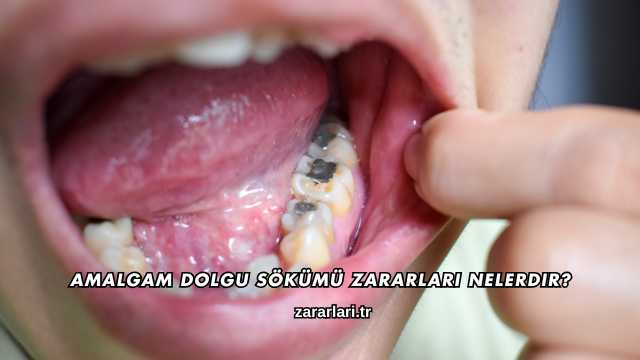 Amalgam Dolgu Sökümü Zararları Nelerdir?