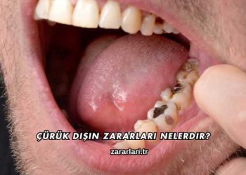 Çürük Dişin Zararları Nelerdir?