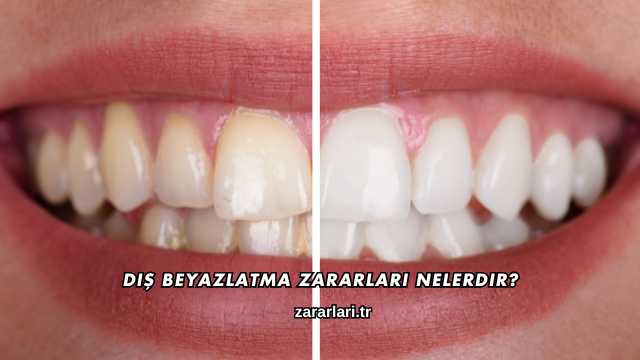 Diş Beyazlatma Zararları Nelerdir?