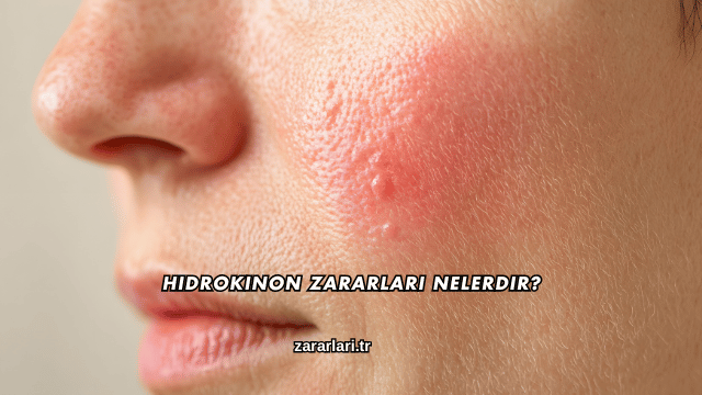 Hidrokinon Zararları Nelerdir?