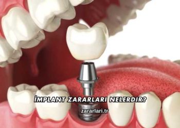 İmplant Zararları Nelerdir?