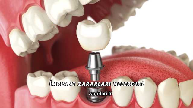 İmplant Zararları Nelerdir?
