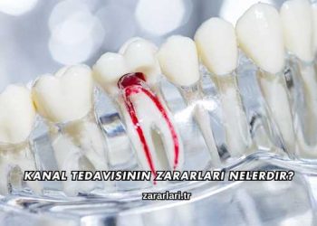 Kanal Tedavisinin Zararları Nelerdir?