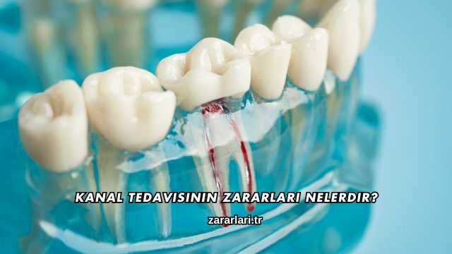 Kanal Tedavisinin Zararları Nelerdir?