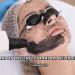 Karbon Peeling Zararları Nelerdir?