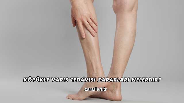 Köpükle Varis Tedavisi Zararları Nelerdir?
