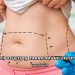 Liposuction Zararları Nelerdir?