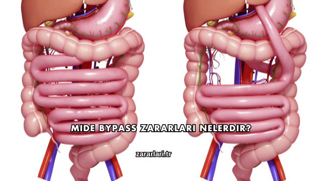Mide Bypass Zararları Nelerdir?