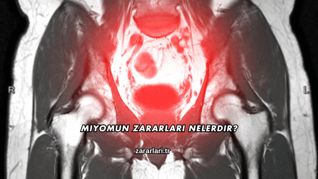Miyomun Zararları Nelerdir?