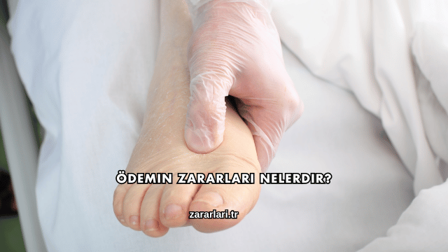 Ödemin Zararları Nelerdir?