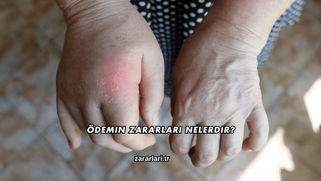 Ödemin Zararları Nelerdir?