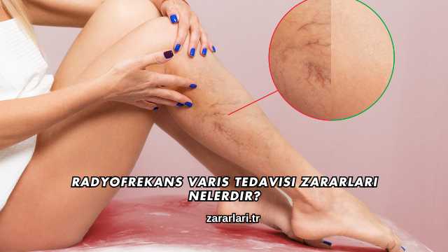 Radyofrekans Varis Tedavisi Zararları Nelerdir?