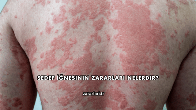 Sedef İğnesinin Zararları Nelerdir?