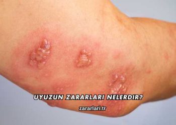 Uyuzun Zararları Nelerdir